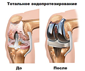 Тотальное эндопротезирование колена