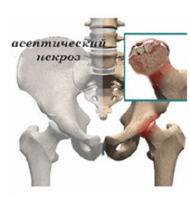 Аваскулярный синдром: симптомы, диагностика, лечение