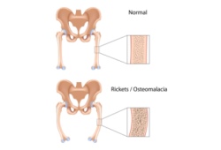 Рахит: симптомы и лечение